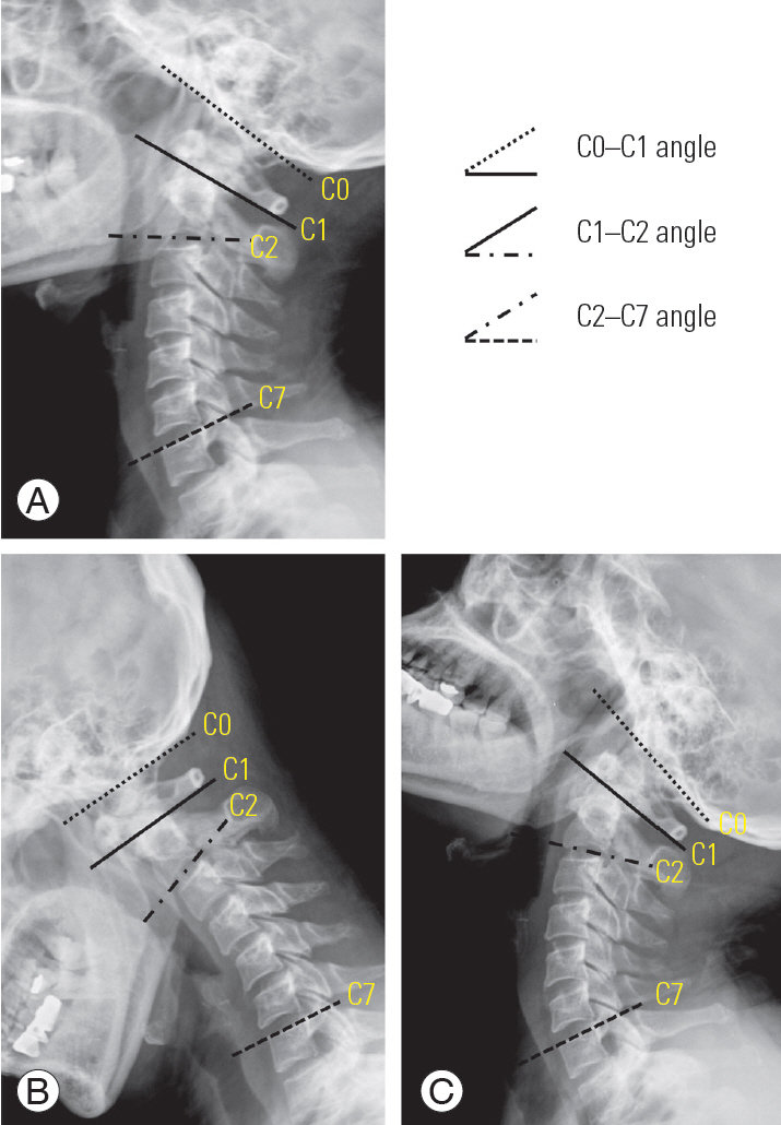 Influence Of Atlantoaxial Fusion On Sagittal Alignment Of The Occipitocervical And Subaxial Spines In Os Odontoideum With Atlantoaxial Instability
