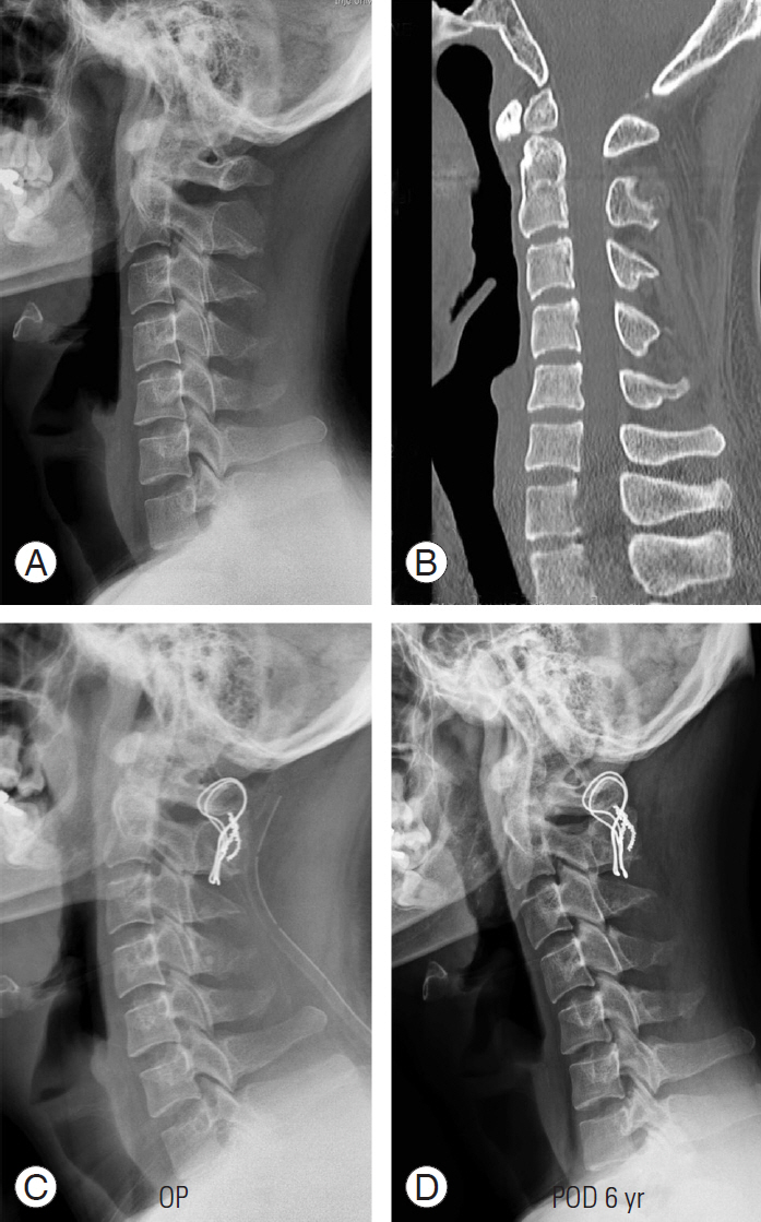 Influence Of Atlantoaxial Fusion On Sagittal Alignment Of The Occipitocervical And Subaxial Spines In Os Odontoideum With Atlantoaxial Instability