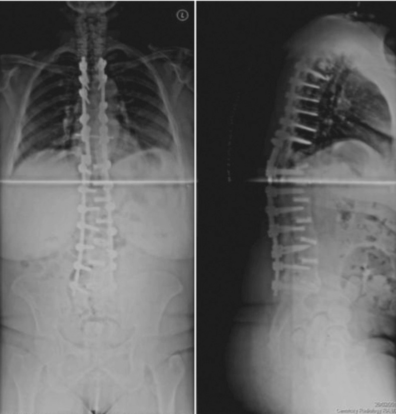 Acute Paraplegia Secondary to Thoracic Disc Herniation of the Adjacent  Segment Following Thoracolumbar Fusion and Instrumentation